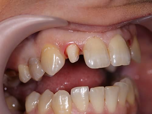 Incisivi laterali pregătiți pentru a fi îmbrăcați cu coroane