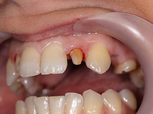 Incisivi laterali pregătiți pentru a fi îmbrăcați cu coroane