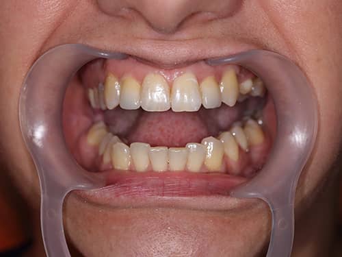 Coroane Dentare ceramice e-Max