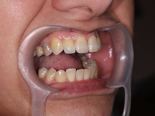 Coroane Dentare ceramice e-Max