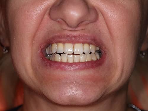 Coroane Dentare ceramice e-Max