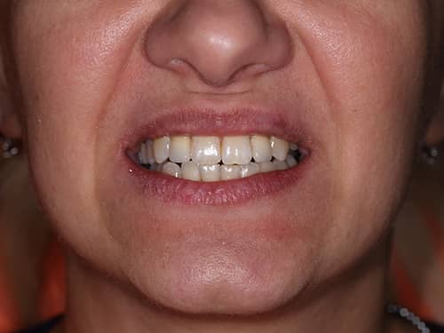 Coroane Dentare ceramice e-Max