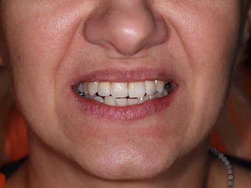 Coroane Dentare ceramice e-Max