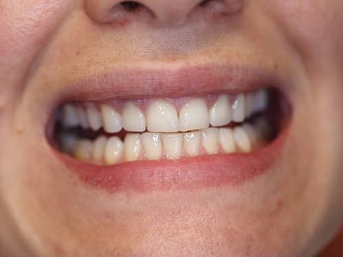 Coroane Dentare ceramice e-Max