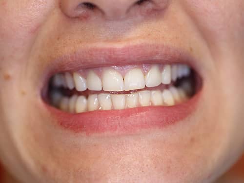 Coroane Dentare ceramice e-Max