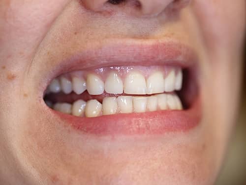 Coroane Dentare ceramice e-Max