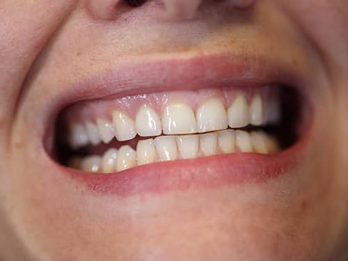 Coroane Dentare ceramice e-Max