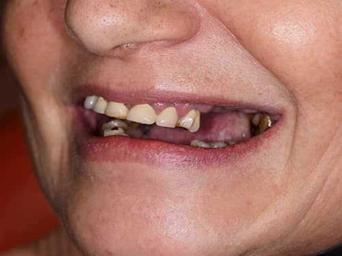 Lucrări dentare vechi sparte și inestetice