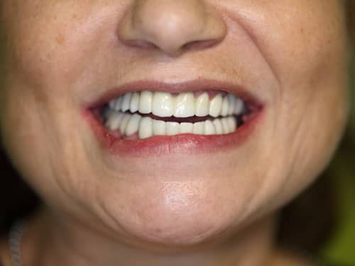 Lucrări din Full-Zirconia (oxid de Zirconiu) pe Implanturi Dentare