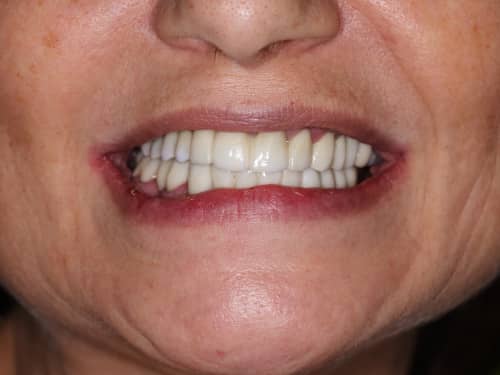 Lucrări din Full-Zirconia (oxid de Zirconiu) pe Implanturi Dentare