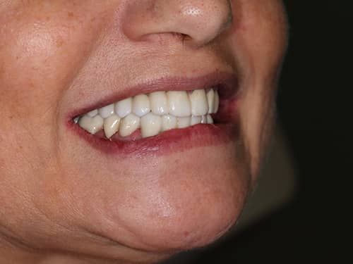 Lucrări din Full-Zirconia (oxid de Zirconiu) pe Implanturi Dentare