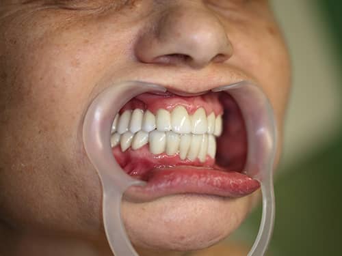 Lucrări din Full-Zirconia (oxid de Zirconiu) pe Implanturi Dentare