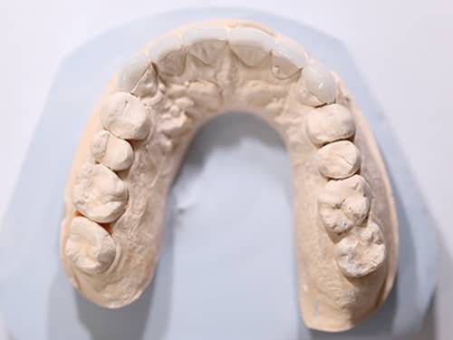 Fațete Dentare ceramice e-Max