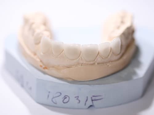 Fațete Dentare ceramice e-Max