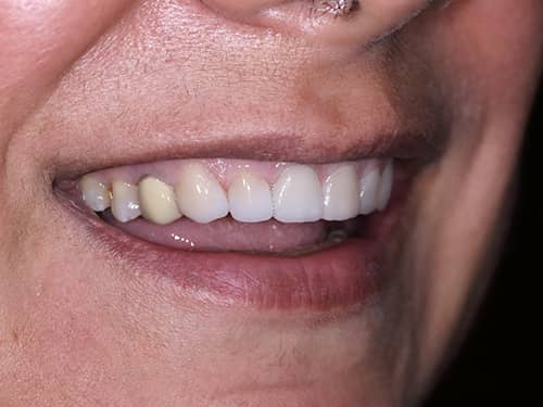 Fațete Dentare ceramice e-Max