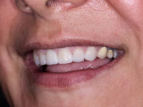 Fațete Dentare ceramice e-Max