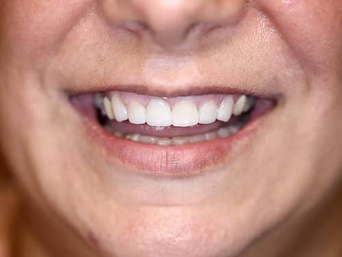 Fațete Dentare ceramice e-Max