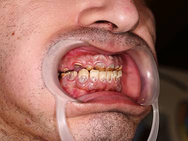 Dinți cariați - amelogenesis imperfecta