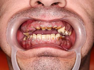 Dinți cariați - amelogenesis imperfecta