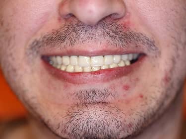 coroane din zirconiu la Dentist Iancului