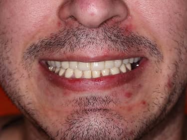 Coroane Dentare din Ceramică pe oxid de Zirconiu