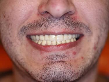 Coroane Dentare din Ceramică pe oxid de Zirconiu