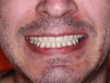 Coroane Dentare din Ceramică pe oxid de Zirconiu