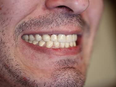 Coroane Dentare din Ceramică pe oxid de Zirconiu