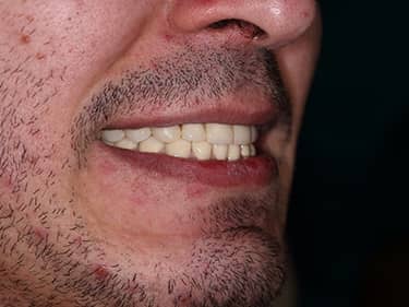 Coroane Dentare din Ceramică pe oxid de Zirconiu