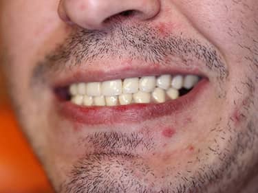 Coroane Dentare din Ceramică pe oxid de Zirconiu