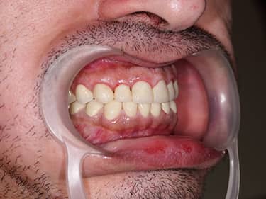 Coroane Dentare din Ceramică pe oxid de Zirconiu