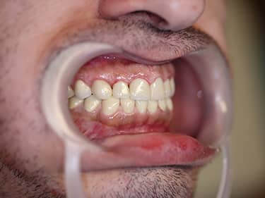 Coroane Dentare din Ceramică pe oxid de Zirconiu