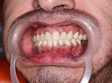 Coroane Dentare din Ceramică pe oxid de Zirconiu