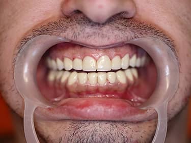 Coroane Dentare din Ceramică pe oxid de Zirconiu