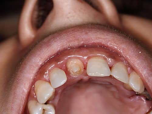 Dinte frontal preparat sub formă de bont pentru a fi acoperit cu o coroniță protetică