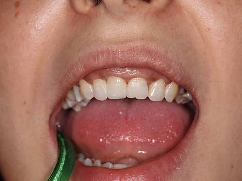 Coroană dentară protetică integral ceramica e-Max pe incisivul central superior