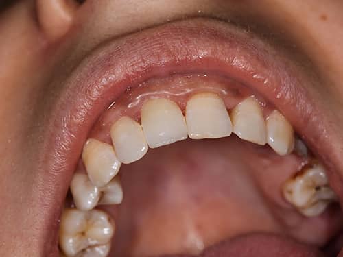 Coroană dentară protetică integral ceramica e-Max pe incisivul central superior