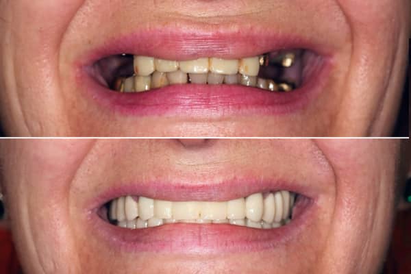 Coroane și Punți Dentare full-Zirconia - Înainte și după tratamentul stomatologic