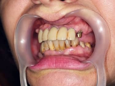 Lucrări protetice dentare vechi și inestetice