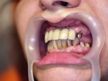 Lucrări protetice dentare vechi și inestetice