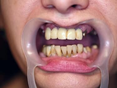 Dificultăți în masticație și estetică dentară