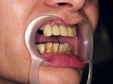 Dificultăți în masticație și estetică dentară