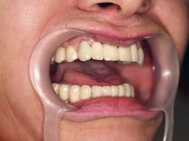 Coroane și Punți Dentare full-Zirconia