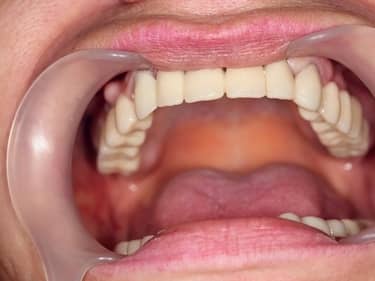 Coroane și Punți Dentare full-Zirconia