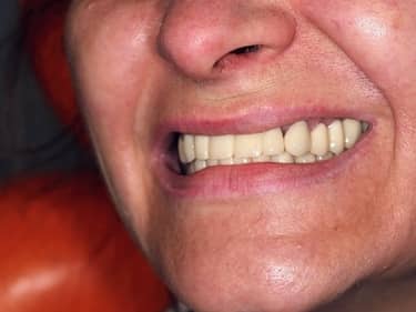 Coroane și Punți Dentare full-Zirconia