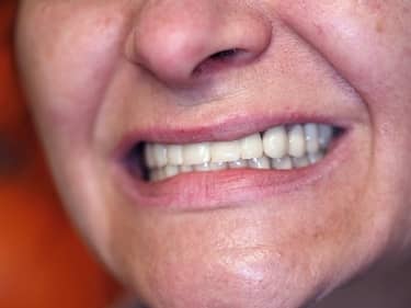 Coroane și Punți Dentare full-Zirconia