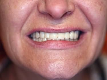 Coroane și Punți Dentare full-Zirconia