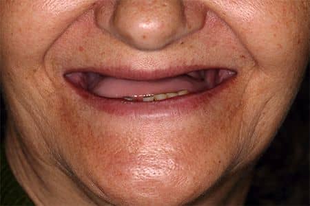 edentatie totala zambet