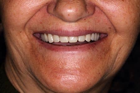 proteze dentare totale zambet