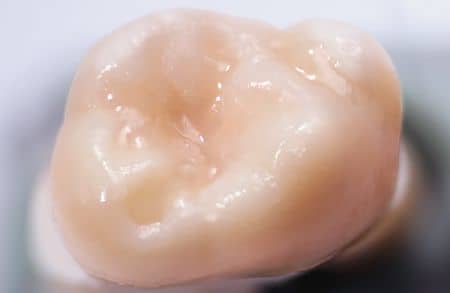 dupa sigilarea dentara